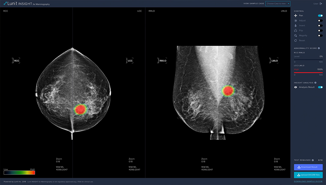 Lunit to Showcase AI Solution for Breast Cancer at SBI 2019