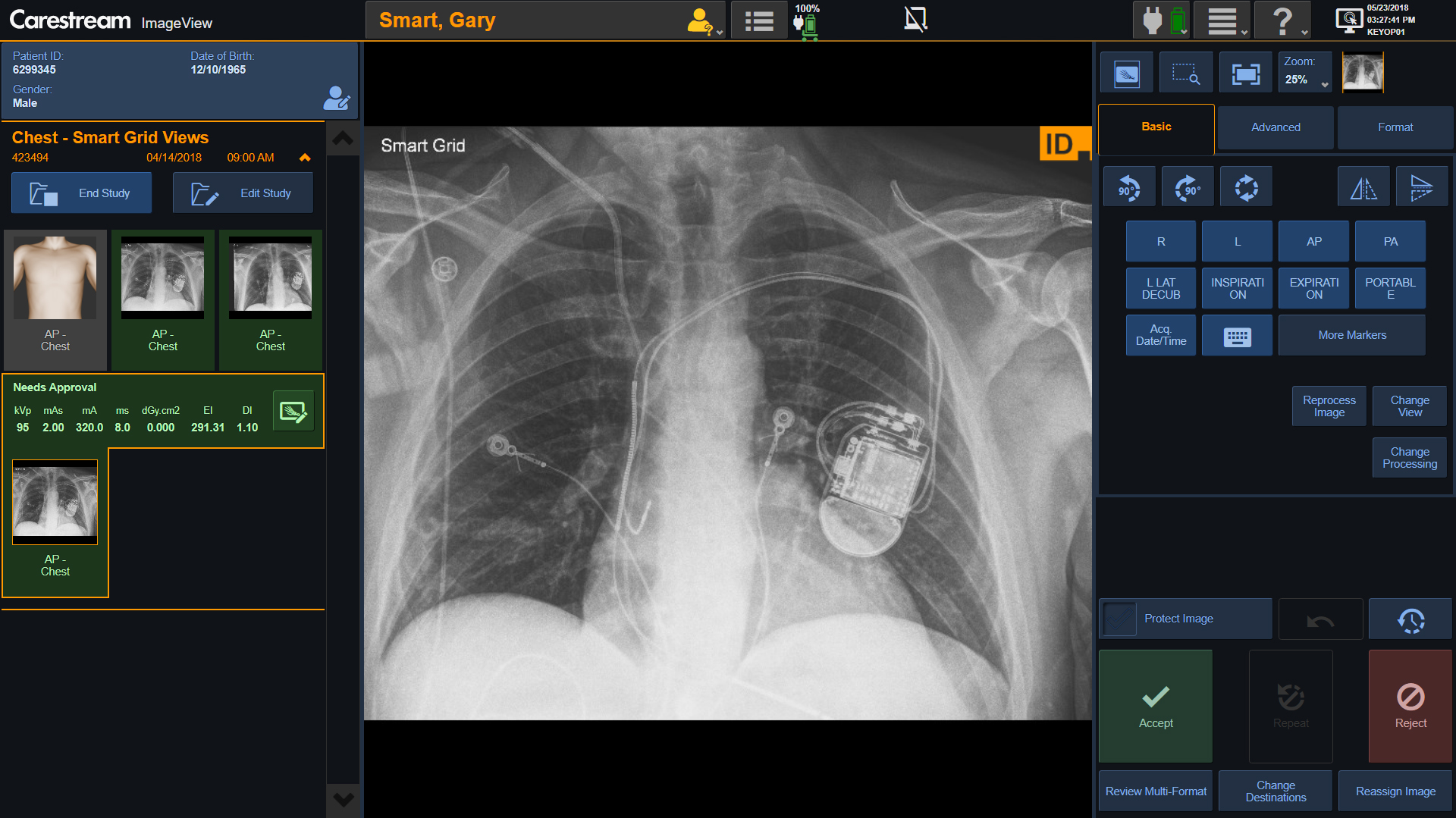 Carestream Releases ImageView Software for DRX-Revolution Mobile X-ray System