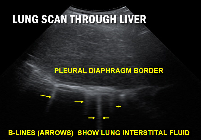 Global Medical Allies Share Lung Ultrasound Solution for COVID-19 Triage