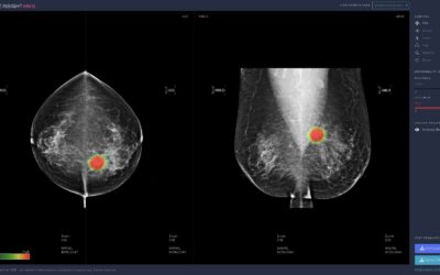 Breast Cancer Imaging and AI