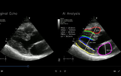RSIP Vision Announces Cardiac Diagnostic Tool for Point-of-Care Ultrasound Screening