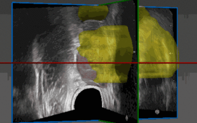 RSIP Vision Launches Advanced AI-Based Tool for Prostate MRI and Ultrasound Registration