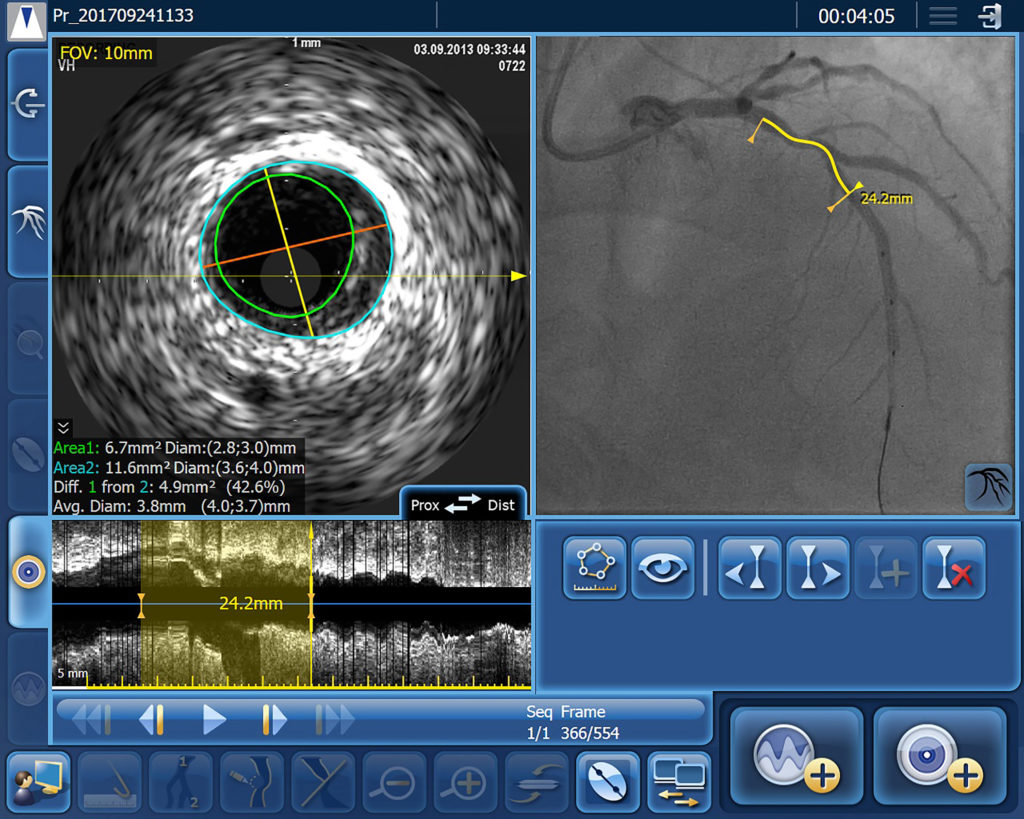 Philips showcases ultra-low contrast PCI solutions at EuroPCR 2022
