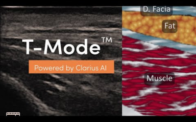 Clarius Invents a New Way to Help Clinicians Instantly Identify Ultrasound Anatomy