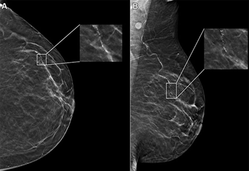 Age, Race Impact AI Performance on Digital Mammograms