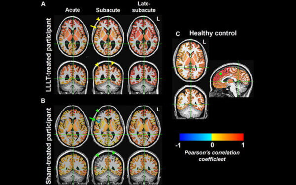 Light Therapy Increases Brain Connectivity Following Injury