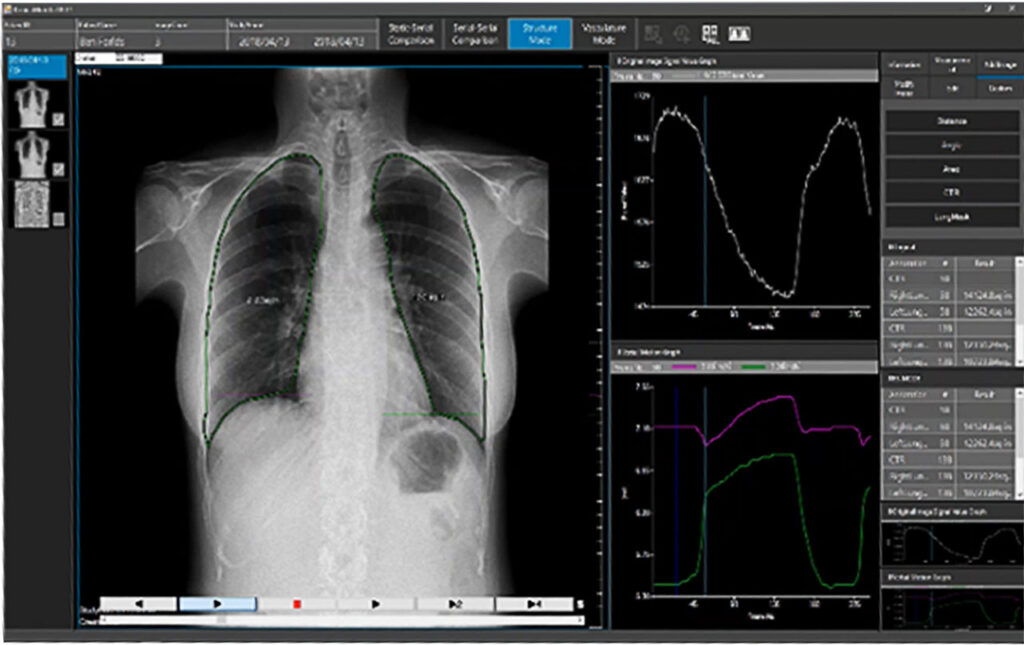 Study Demonstrates the Clinical Value of DDR to Quantitatively Diagnose Diaphragm Dysfunction

