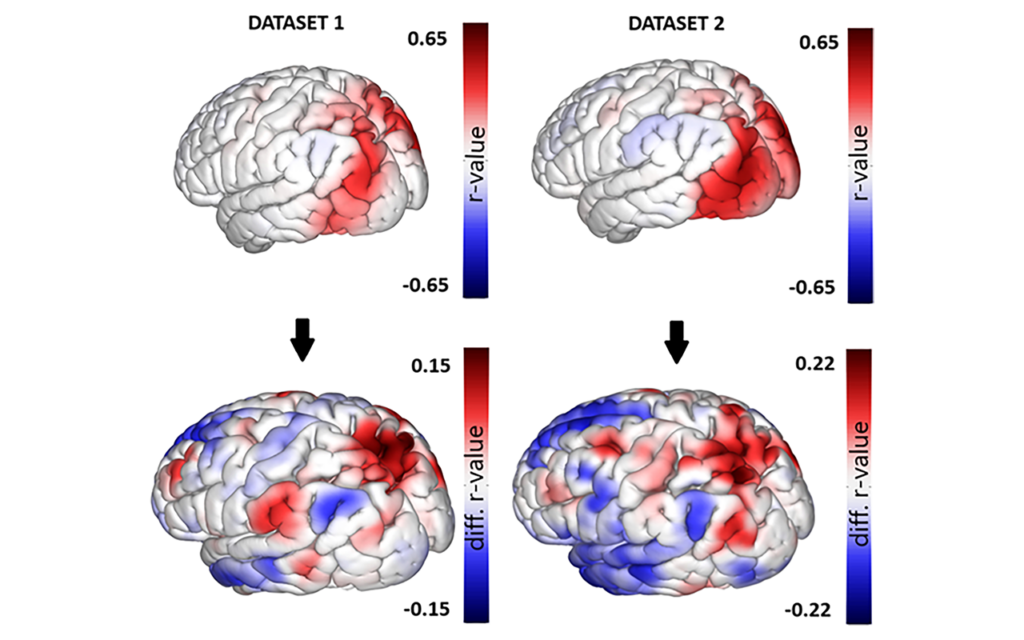 Brain Abnormalities Seen in Military Members with Blast Exposure

