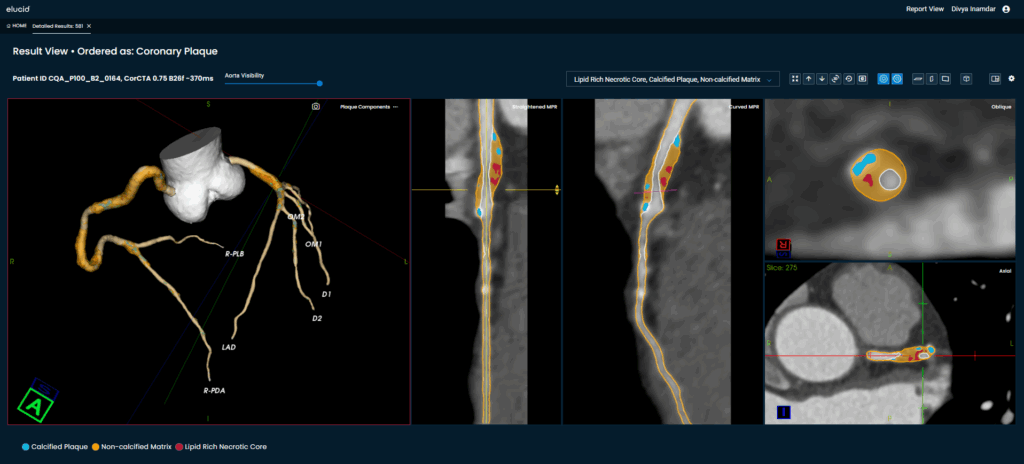 Elucid Applauds CMS Inclusion of Coronary CTA with Plaque Analysis in 2026 Proposed Medicare Physician Fee Schedule

