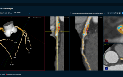 Elucid Applauds CMS Inclusion of Coronary CTA with Plaque Analysis in 2026 Proposed Medicare Physician Fee Schedule