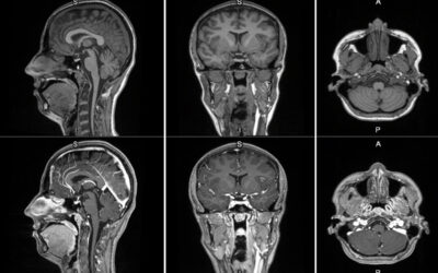 GE HealthCare announces first patient dosed in Phase 2/3 LUMINA trial for manganese-based MRI contrast agent