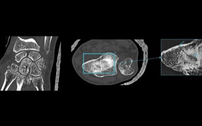 GE HealthCare broadens its deep learning CT portfolio with FDA clearance of True Definition DL