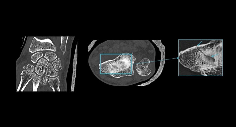 GE HealthCare broadens its deep learning CT portfolio with FDA clearance of True Definition DL

